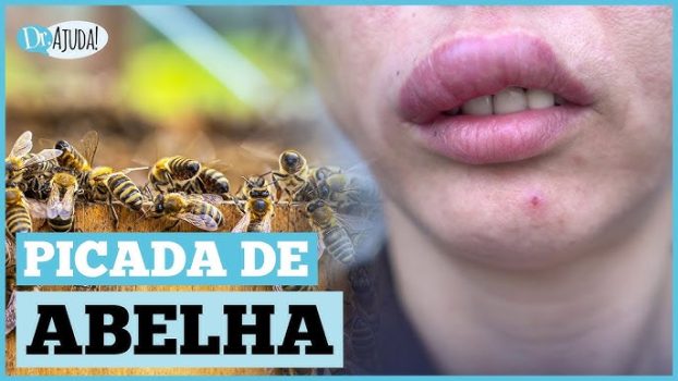 homem picado por abelha