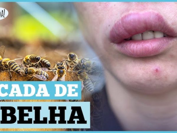 homem picado por abelha